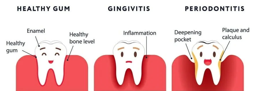 Illustration of healthy gum, gingivitis, and periodontitis side by side