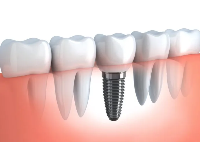 A dental implant placed in the gumline among natural teeth