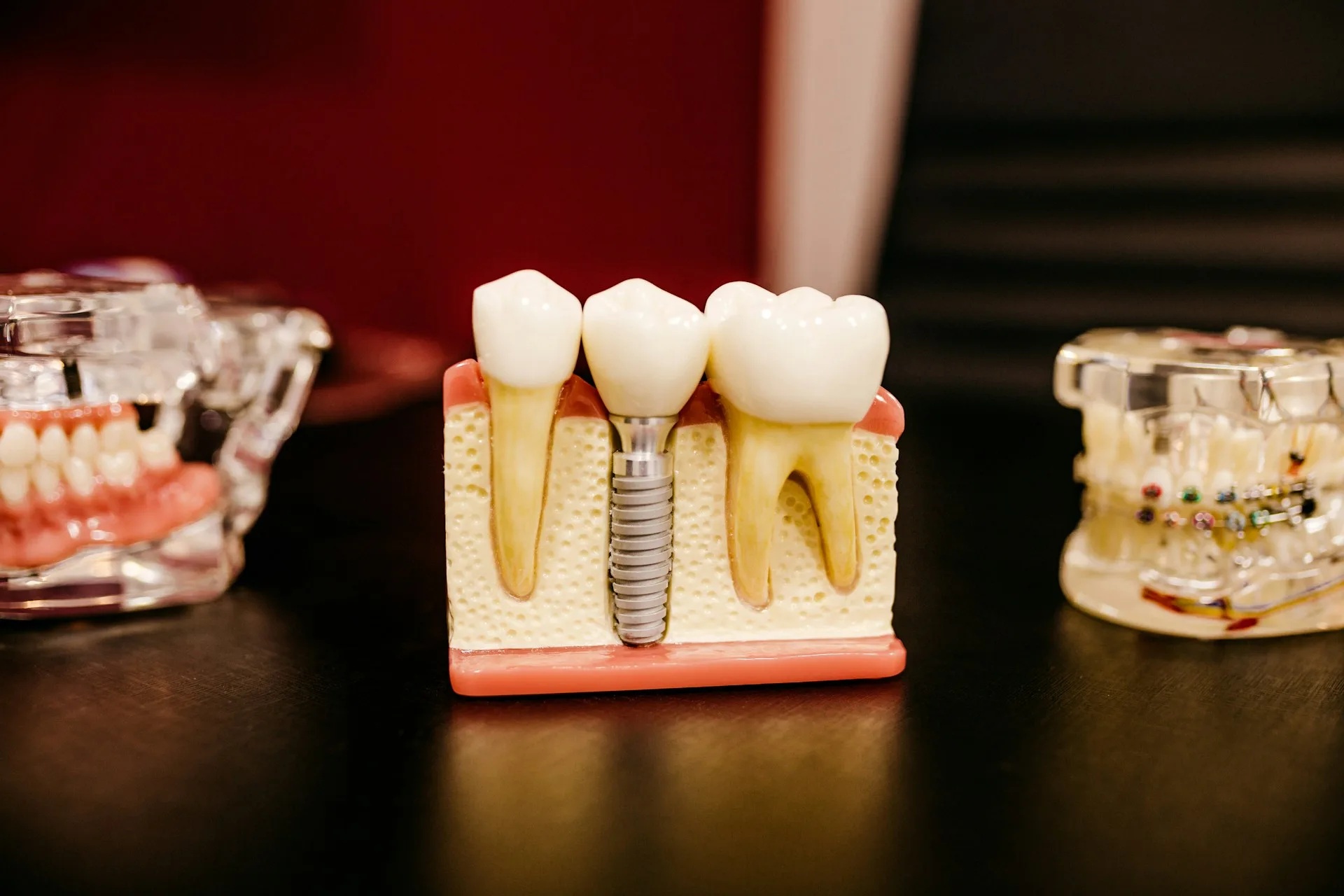 Dental implant model: a titanium post anchored in the jawbone between natural tooth roots, supporting a crown