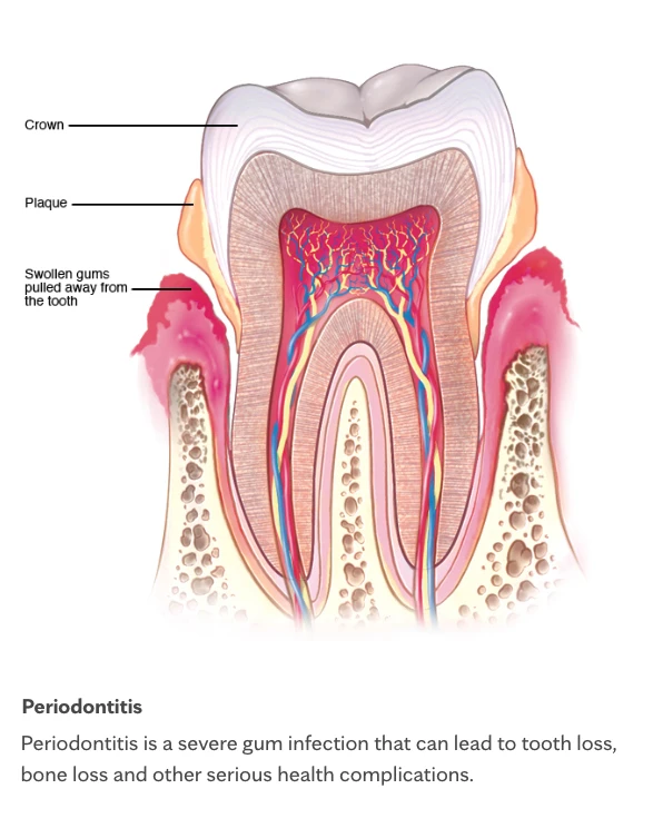 Bone Loss & Regeneration